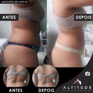 Drenagem linfática: Antes e Depois